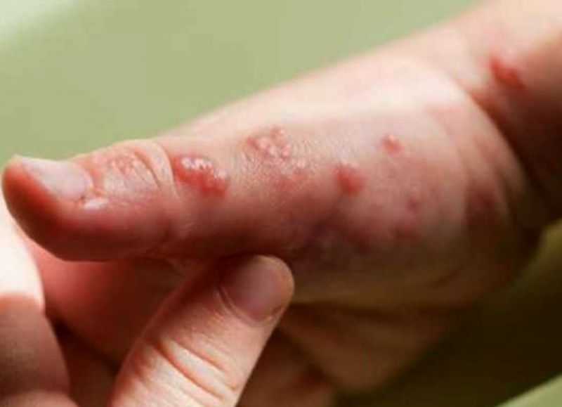 El Gobierno peruano confirma 2 nuevos casos de viruela del mono